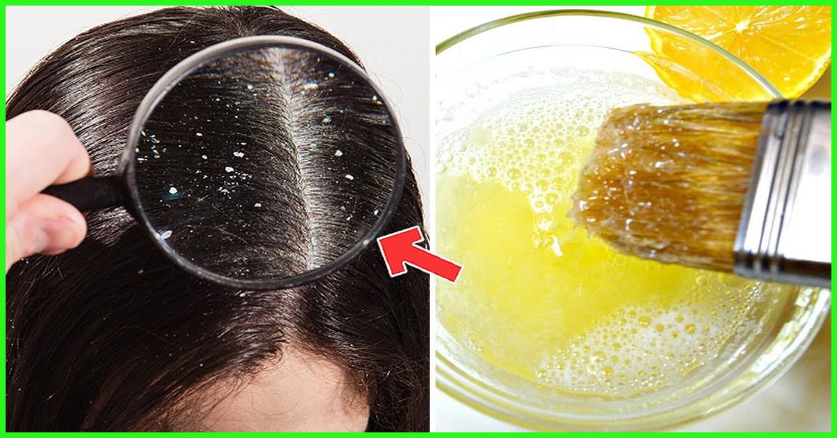 Complete Guide To Cure Dandruff Naturally By Home Remedies Health 24 Life