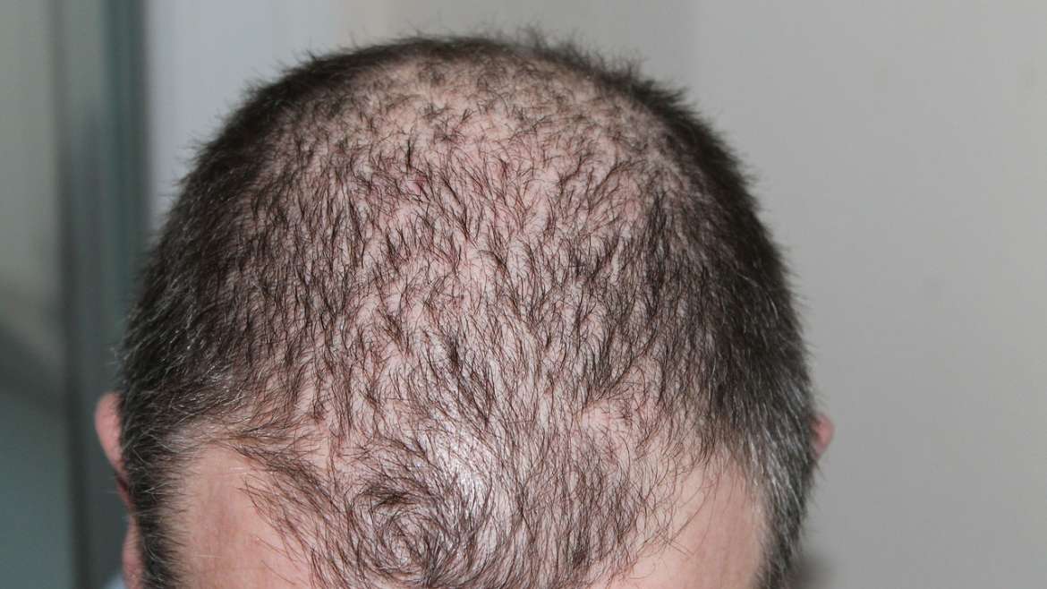 Complete Guide About Hair Loss myths, Causes and how to get rid from Hair Loss
