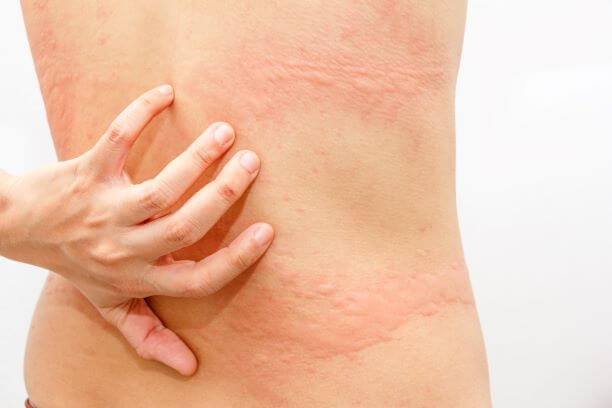 Eczema Disease is Caused Due To These 10 Things